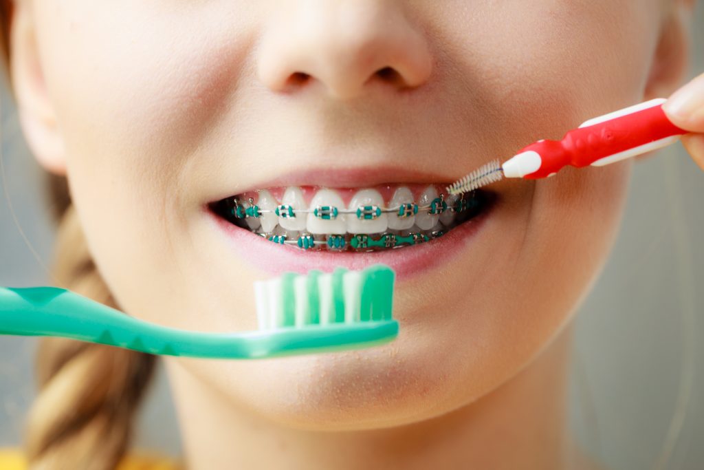 caring for your braces